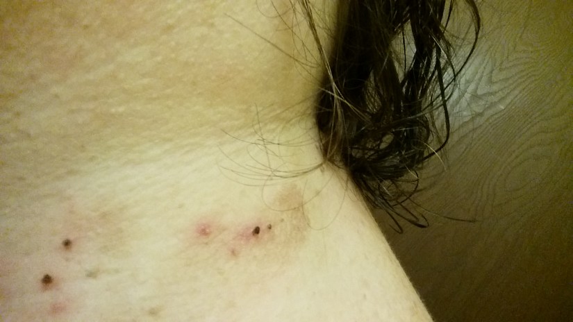 1 Week Later - Skin Tags Turning Purple