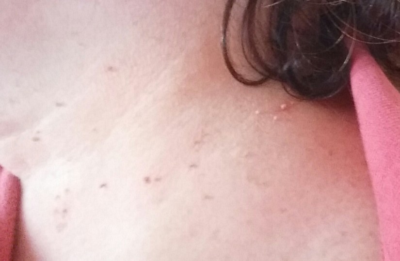 Mom's Skin Tags